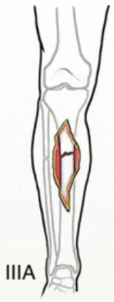 Grade IIIA open fracture clinical illustration